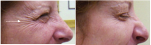 botox before and after photo1